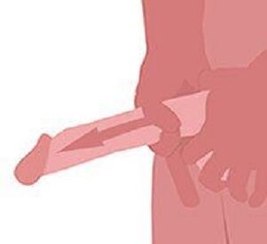 a pénisz péniszének nagyításának módjai merevedés urethritissel